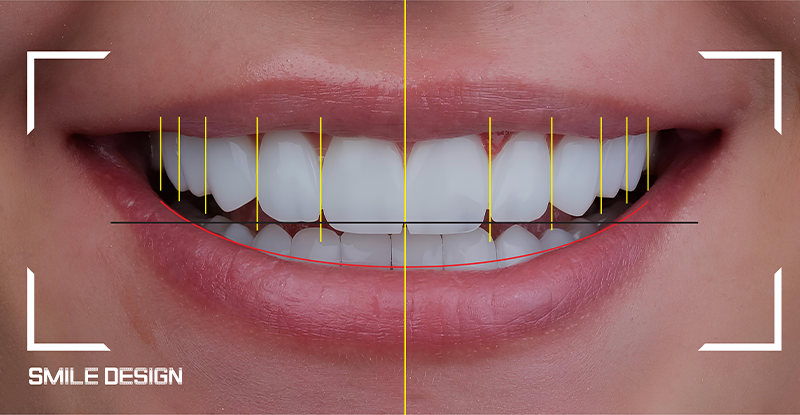 digital smile design